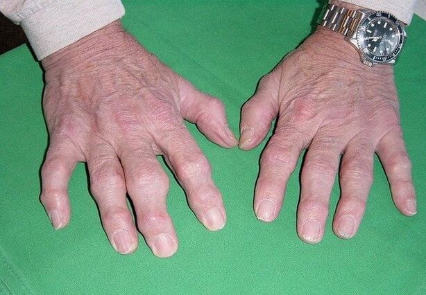 Osteoartritis de los dedos