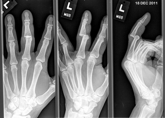 Radiografía de los dedos dislocados
