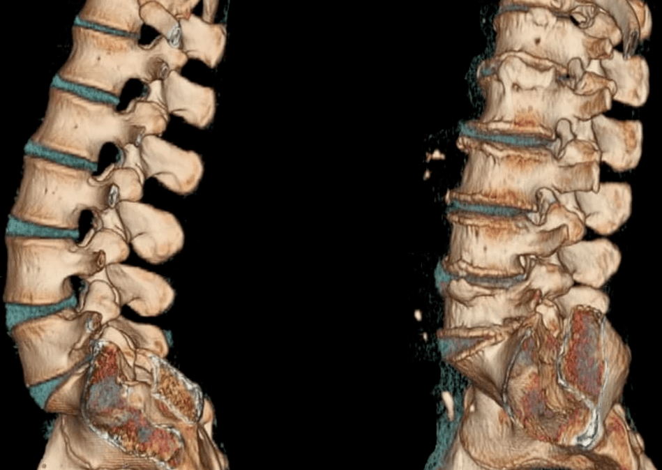 osteocondrosis