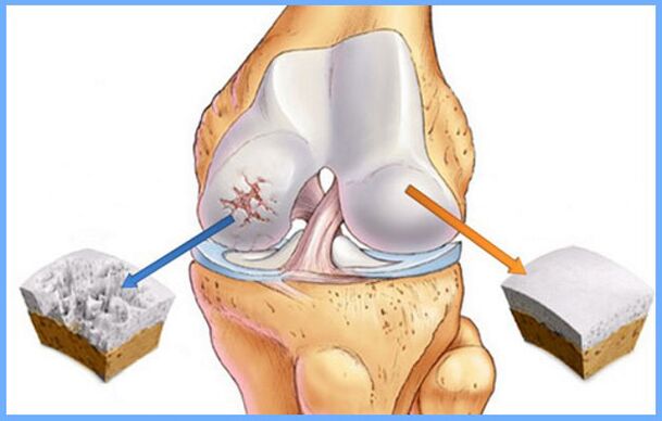 Articulación de rodilla normal y afectada por artrosis. 