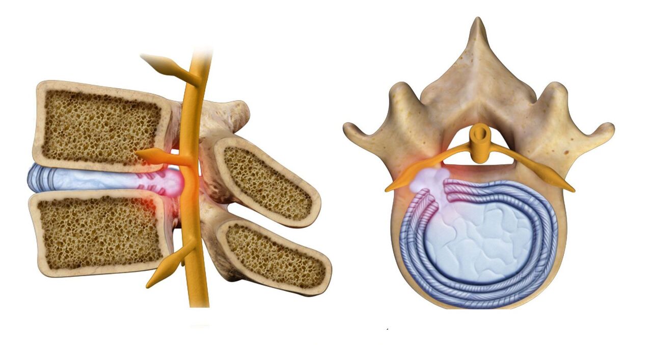 hernia espinal en la osteocondrosis torácica