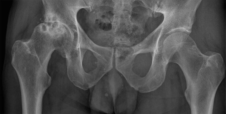 Artrosis deformante de la articulación de la cadera en la radiografía