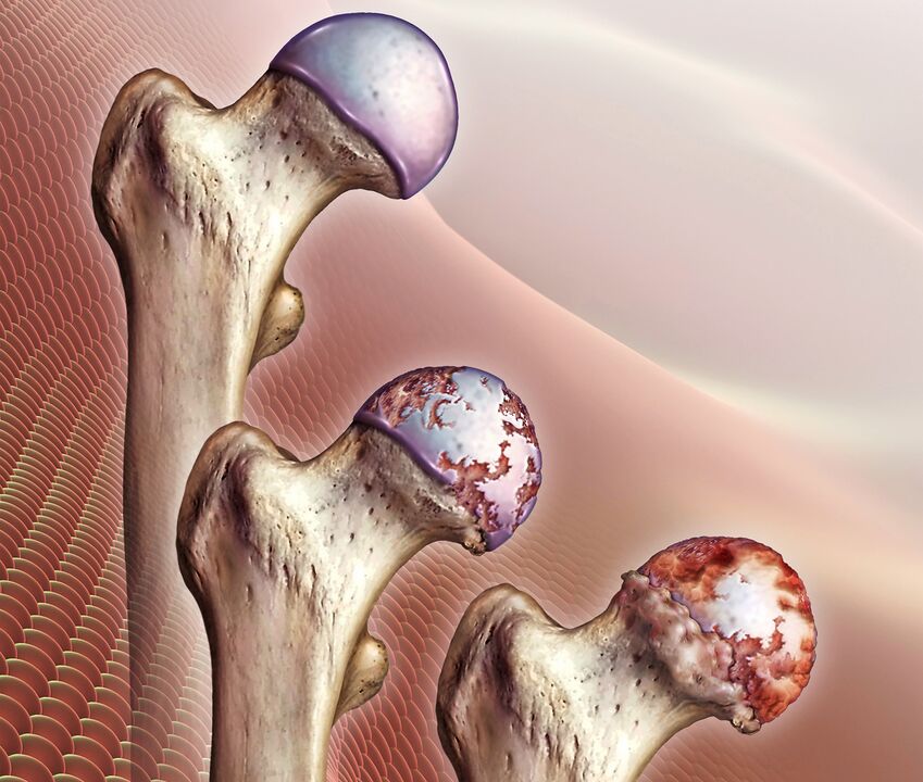 El desarrollo de la artrosis de la articulación de la cadera. 