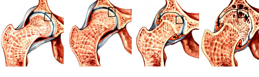 El grado de desarrollo de la coxartrosis de la articulación de la cadera. 