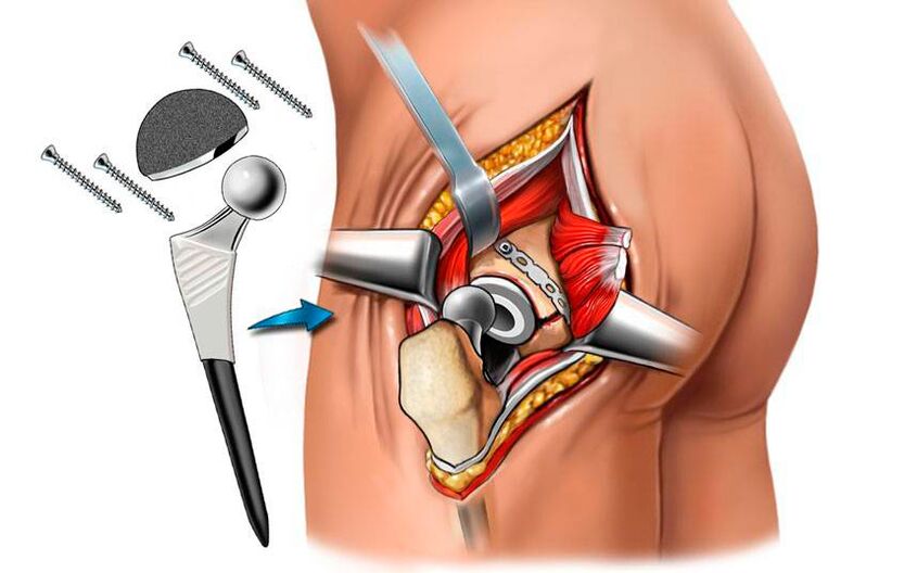 Instalación de una endoprótesis una solución quirúrgica al problema de la coxartrosis. 