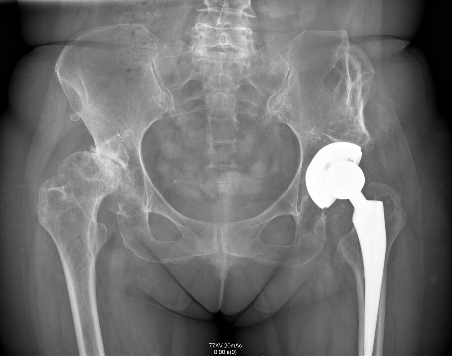 Radiografía de la articulación de la cadera después de la artroplastia