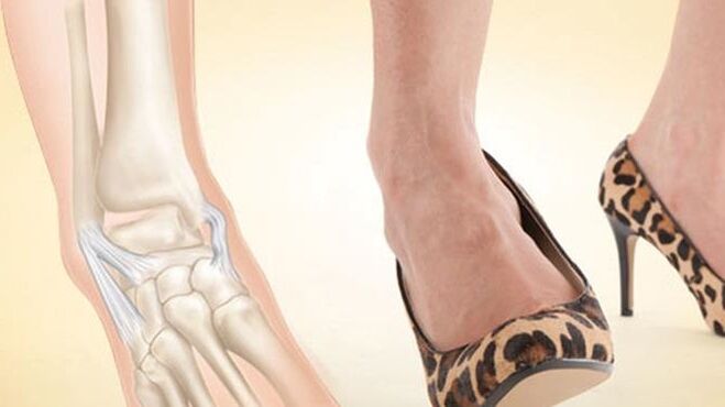 el uso de zapatos con tacones como causa de artrosis de tobillo
