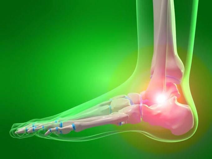 inflamación de la articulación del tobillo con artrosis