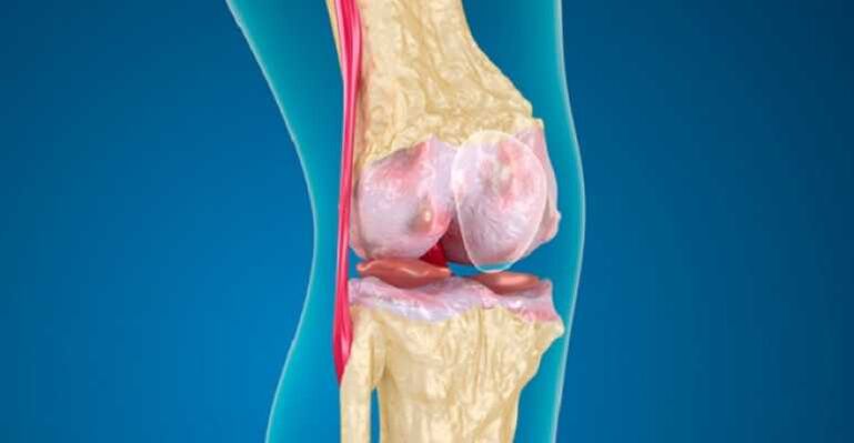 Artrosis de la enfermedad de la articulación de la rodilla, lo que causa la destrucción del cartílago en las articulaciones