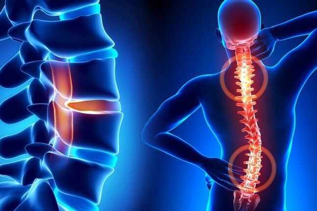 Osteocondrosis de la columna